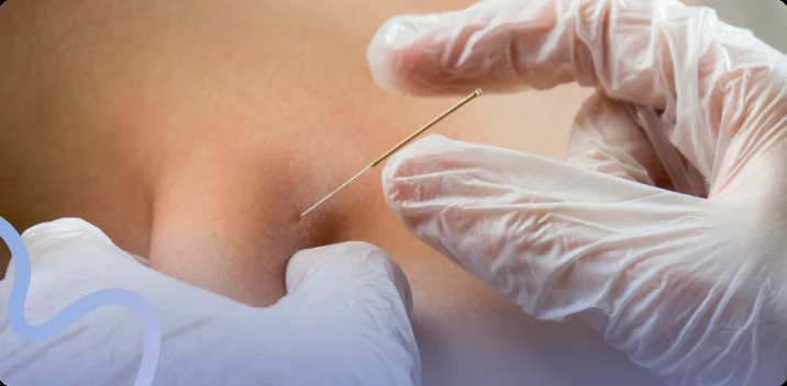 Gloved hands inserting a thin dry needling needle into a patient's shoulder muscle